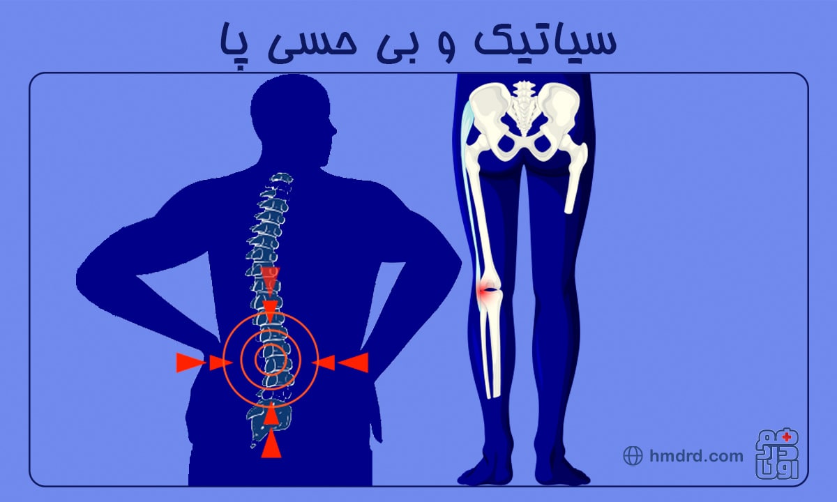 راهنمای جامع برای درک و درمان سیاتیک و بی حسی پا