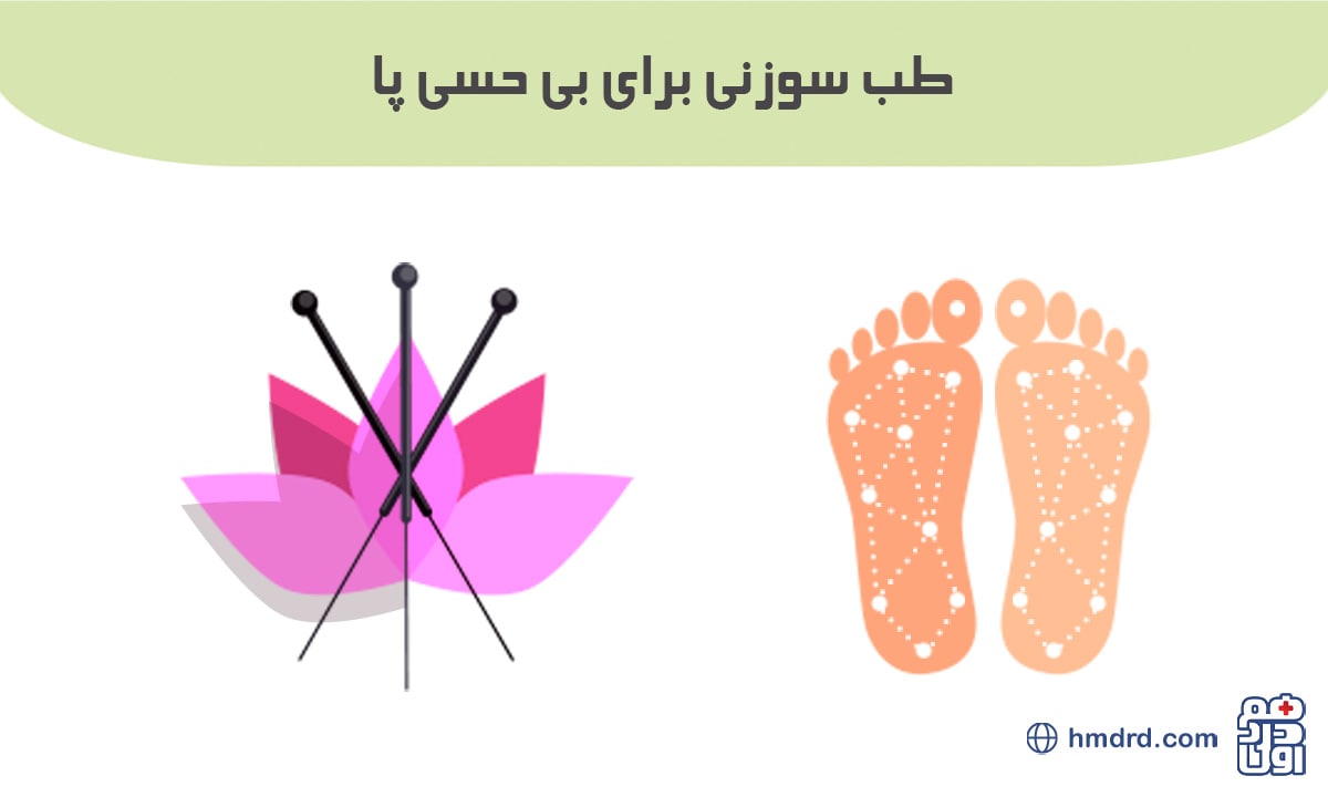 آنچه باید درباره طب سوزنی برای بی حسی پا بدانید