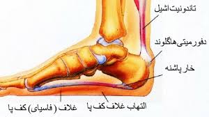 برای درد کف پا به چه پزشکی مراجعه کنیم