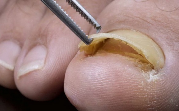 دکتر فوق تخصص ناخن در تهران