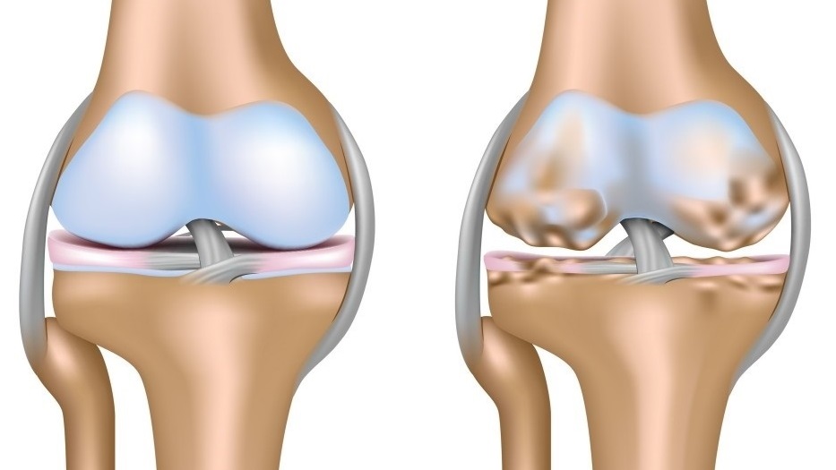 برای درد مفصل شانه چه باید کرد
