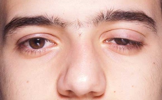 برای افتادگی پلک به چه دکتری مراجعه کنیم